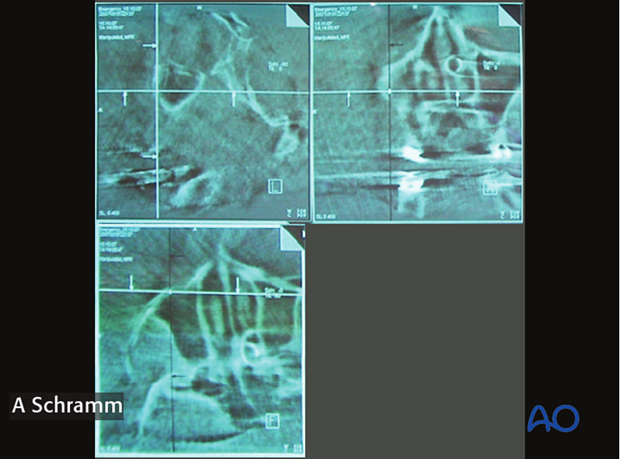 cas intraoperative imaging orif without orbital reconstruction