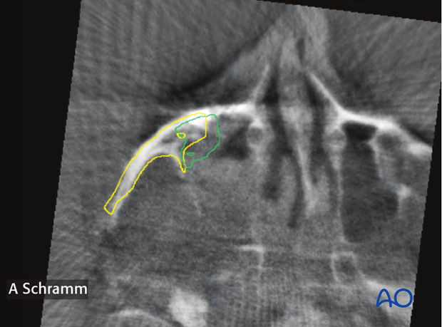 zygomatic complex fracture