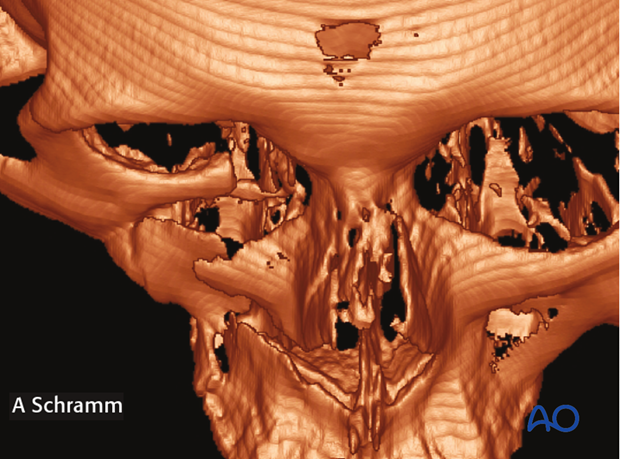 zygomatic complex fracture