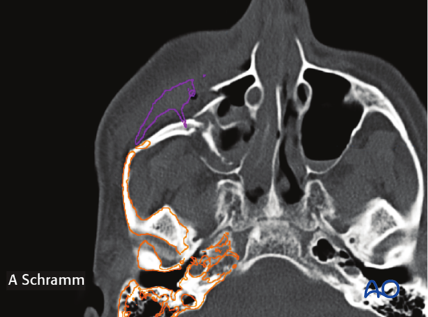 cas virtual planning and intraoperative imaging orif with orbital reconstruction