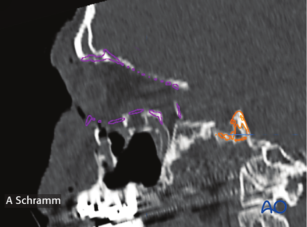 cas virtual planning and intraoperative imaging orif with orbital reconstruction