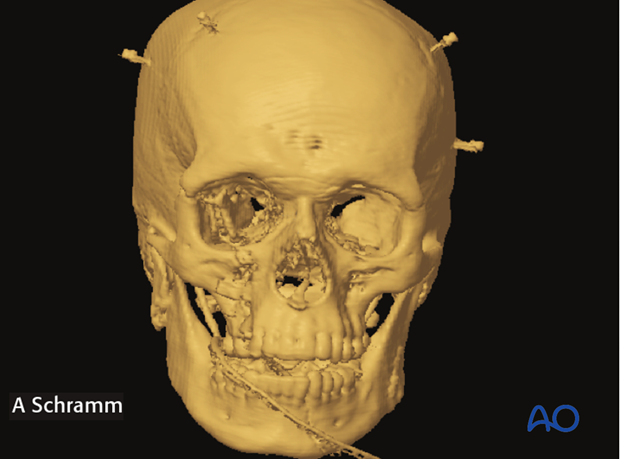 cas virtual planning and intraoperative navigation orif with orbital reconstruction