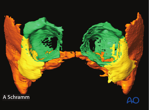 cas virtual planning and intraoperative navigation orif with orbital reconstruction