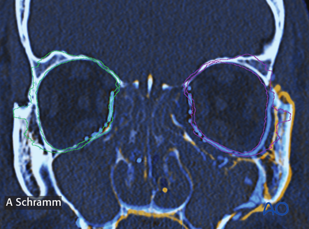 cas virtual planning and intraoperative navigation orif with orbital reconstruction