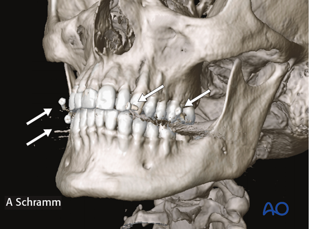 computer assisted surgery orbit virtual planning and intraoperative navigation