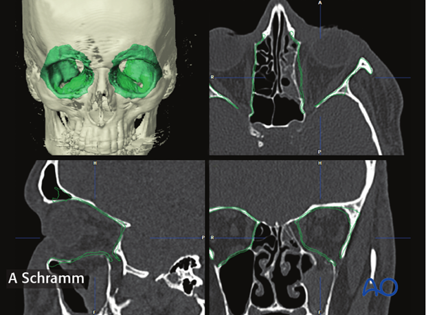 computer assisted surgery orbit virtual planning and intraoperative navigation