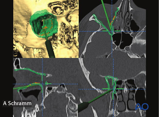 computer assisted surgery orbit virtual planning and intraoperative navigation