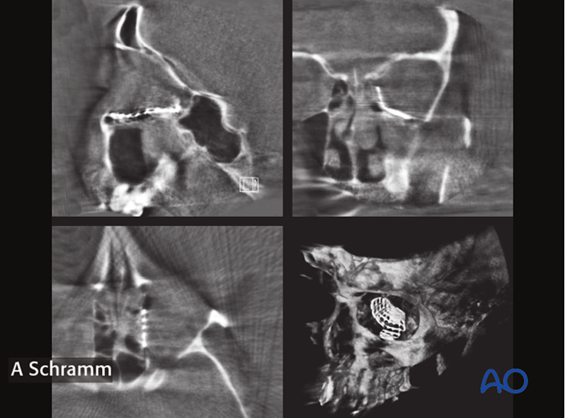 computer assisted surgery orbit virtual planning and intraoperative navigation