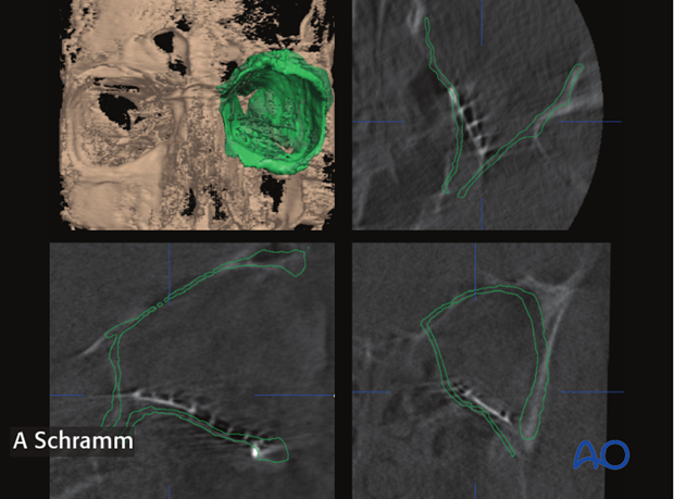 computer assisted surgery orbit virtual planning and intraoperative navigation