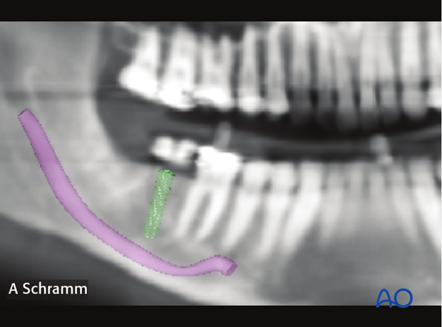 computer assisted dental implant surgery