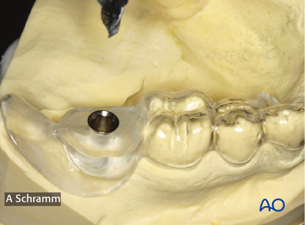 computer assisted dental implant surgery