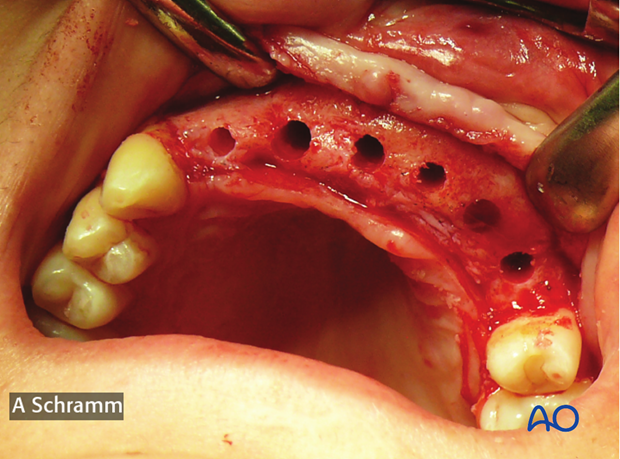 computer assisted dental implant surgery