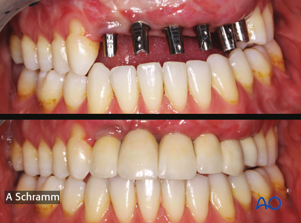 computer assisted dental implant surgery