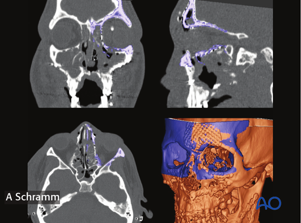 computer assisted surgery gunshot virtual planning and intraoperative navigation gunshot