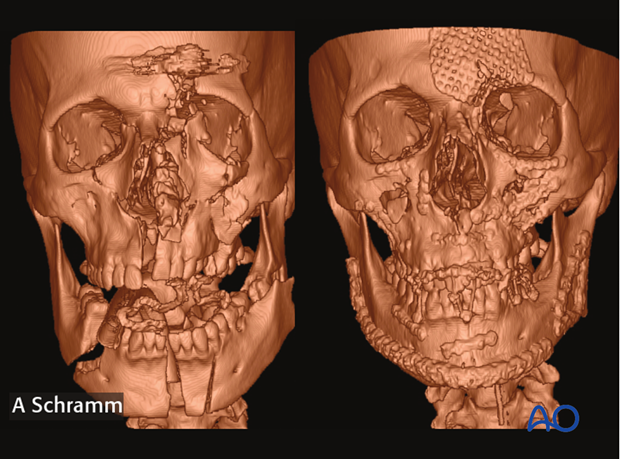 computer assisted surgery gunshot virtual planning and intraoperative navigation gunshot