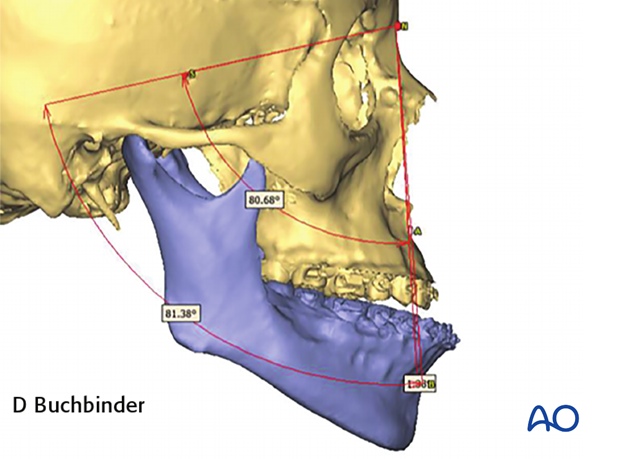 CAS computer assisted surgery