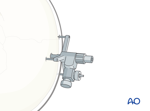 CAS preparation for intraoperative navigation