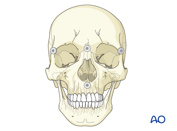 CAS preparation for intraoperative navigation