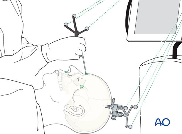 CAS preparation for intraoperative navigation