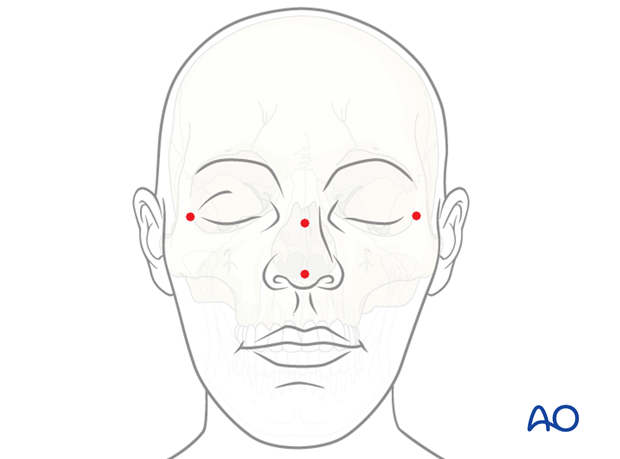 CAS preparation for intraoperative navigation