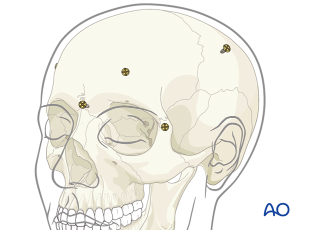 CAS preparation for intraoperative navigation