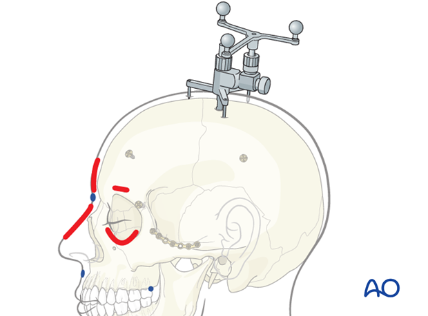 CAS preparation for intraoperative navigation