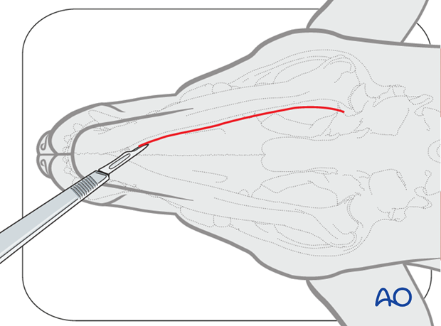 Ventral approach to mandibular body skin incision|alt