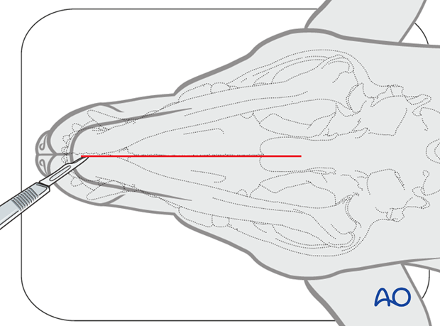 Ventral approach to mandibular body skin incision|alt