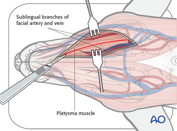 Ventral approach to mandibular body anatomical exposure|alt