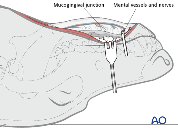 Ventral approach to mandibular body mucogingival junction protection|alt