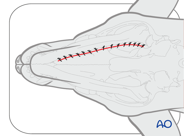 Ventral approach to mandibular body closure|alt