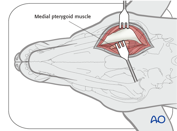 Ventral approach to caudal mandible anatomical exposure medial pterygoid muscle|alt