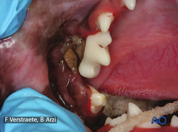 complications with mandible fractures