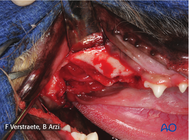 complications with mandible fractures