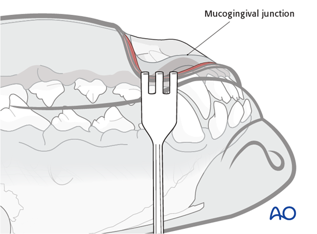 Ventral approach to rostral mandible mucogingival junction protection|alt