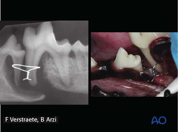 complications with mandible fractures