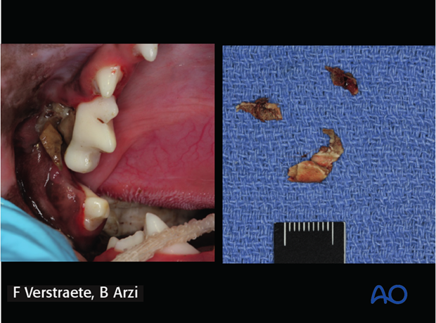 complications with mandible fractures