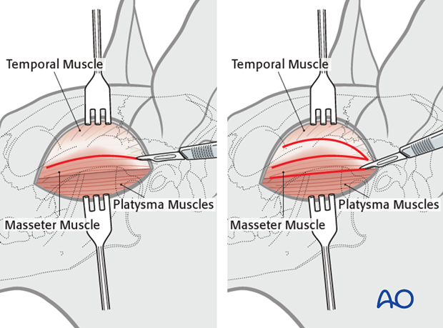 lateral approach to the zygomatic arch