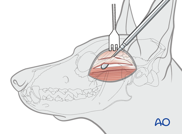 lateral approach to the zygomatic arch