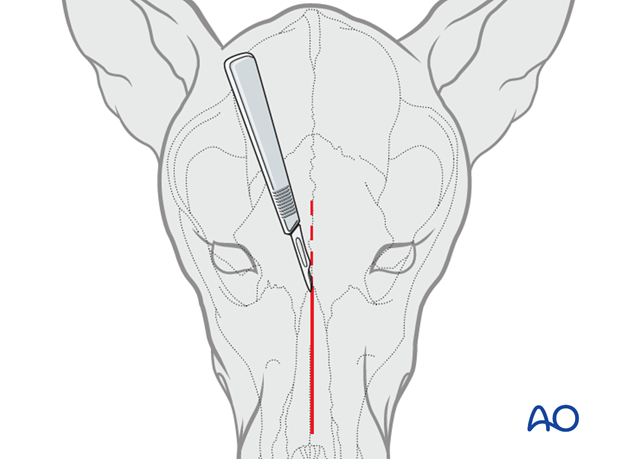 plate fixation