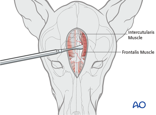 dorsal midline approach