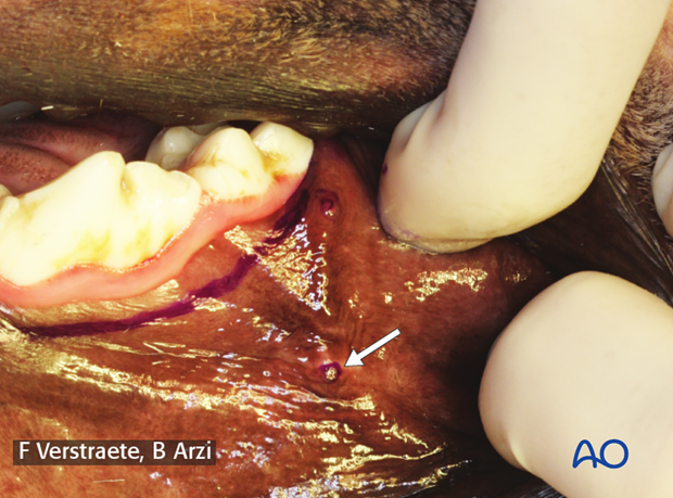 intraoral approach to the maxilla