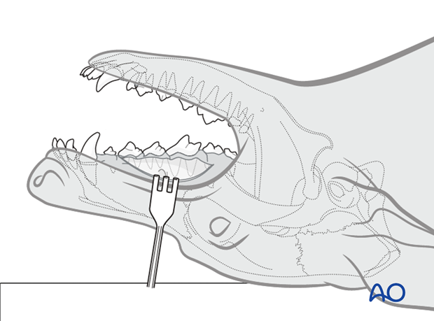 intraoral approach to the maxilla