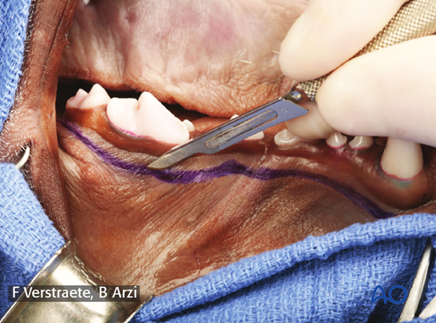 intraoral approach to the maxilla