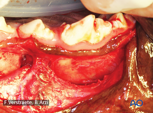 intraoral approach to the maxilla