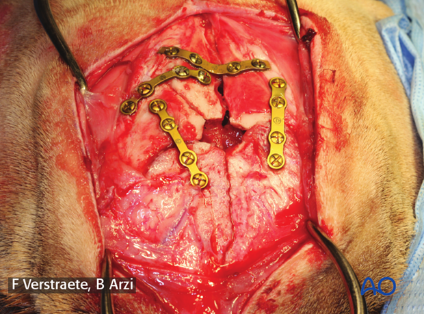 general considerations with midface fractures