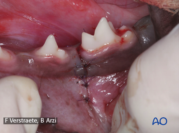 management of fractures in the pediatric patient