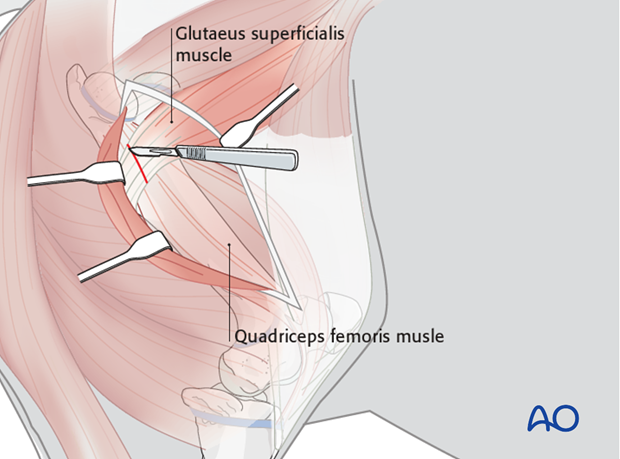 lateral approach to the femur