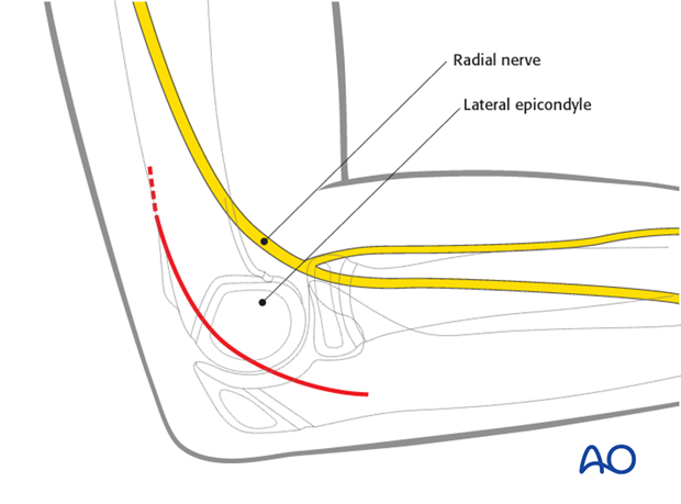 Lateral approach