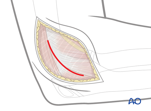 lateral approach